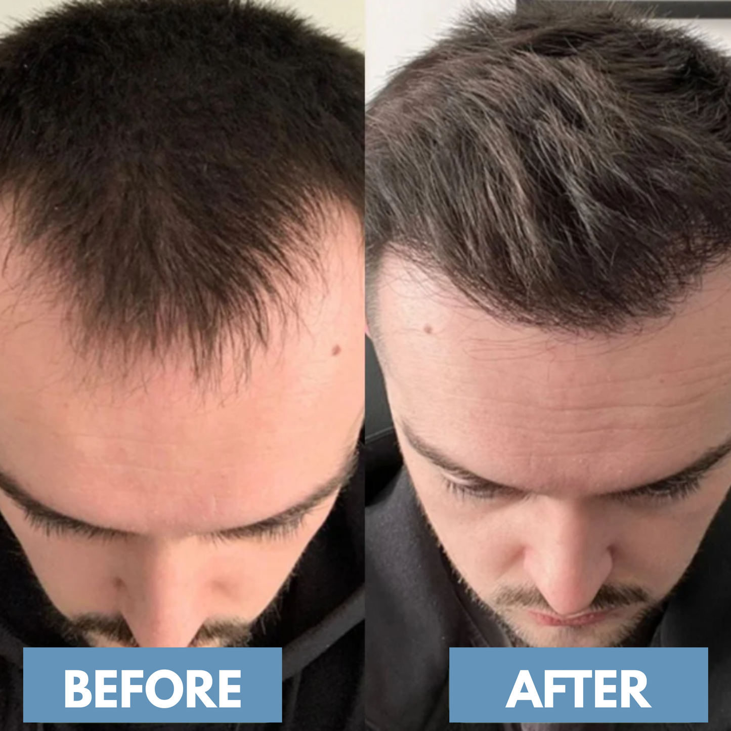 Regrow Thicker, Fuller Hair Naturally
